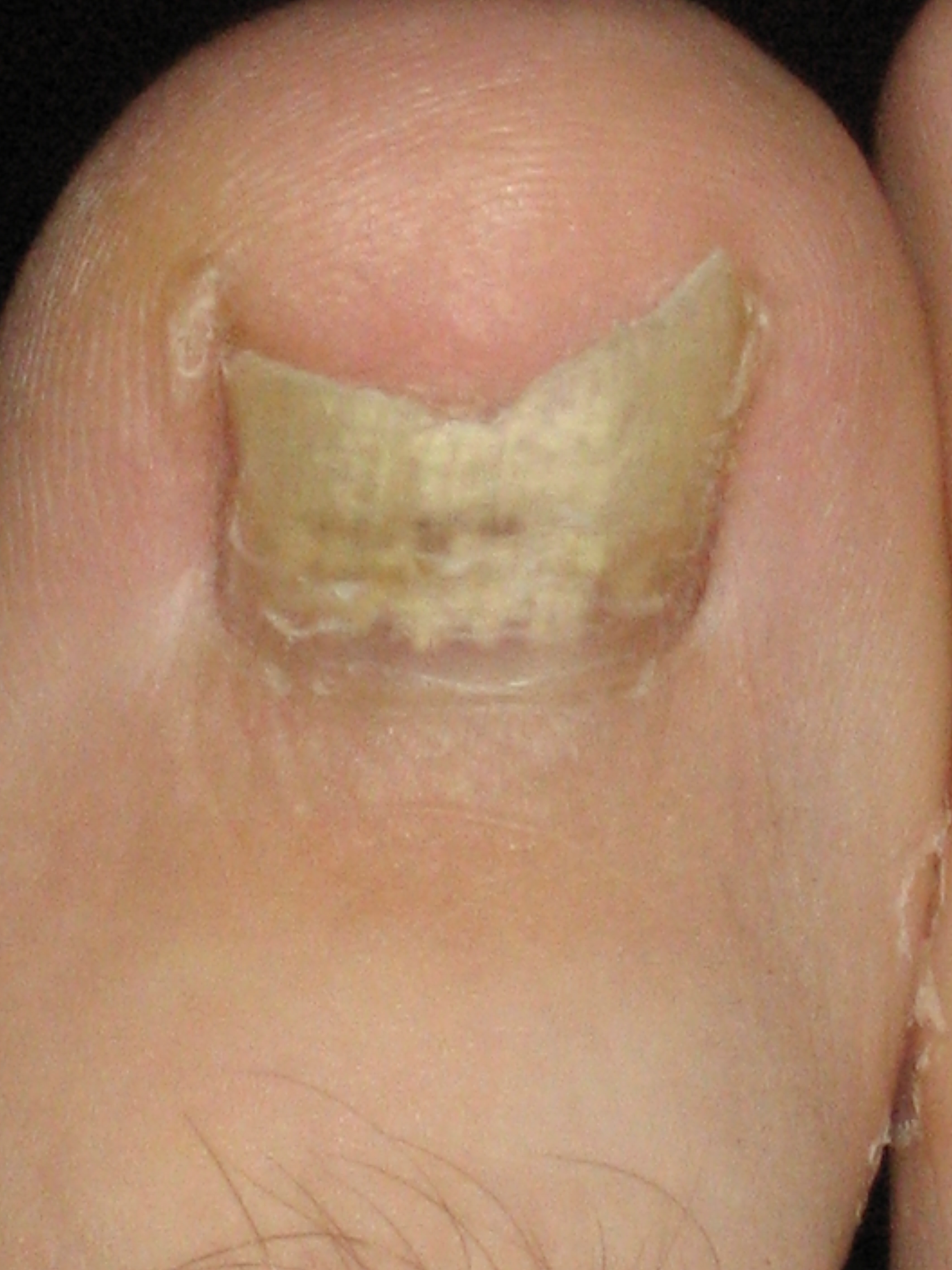Micose nas unhas dos pés