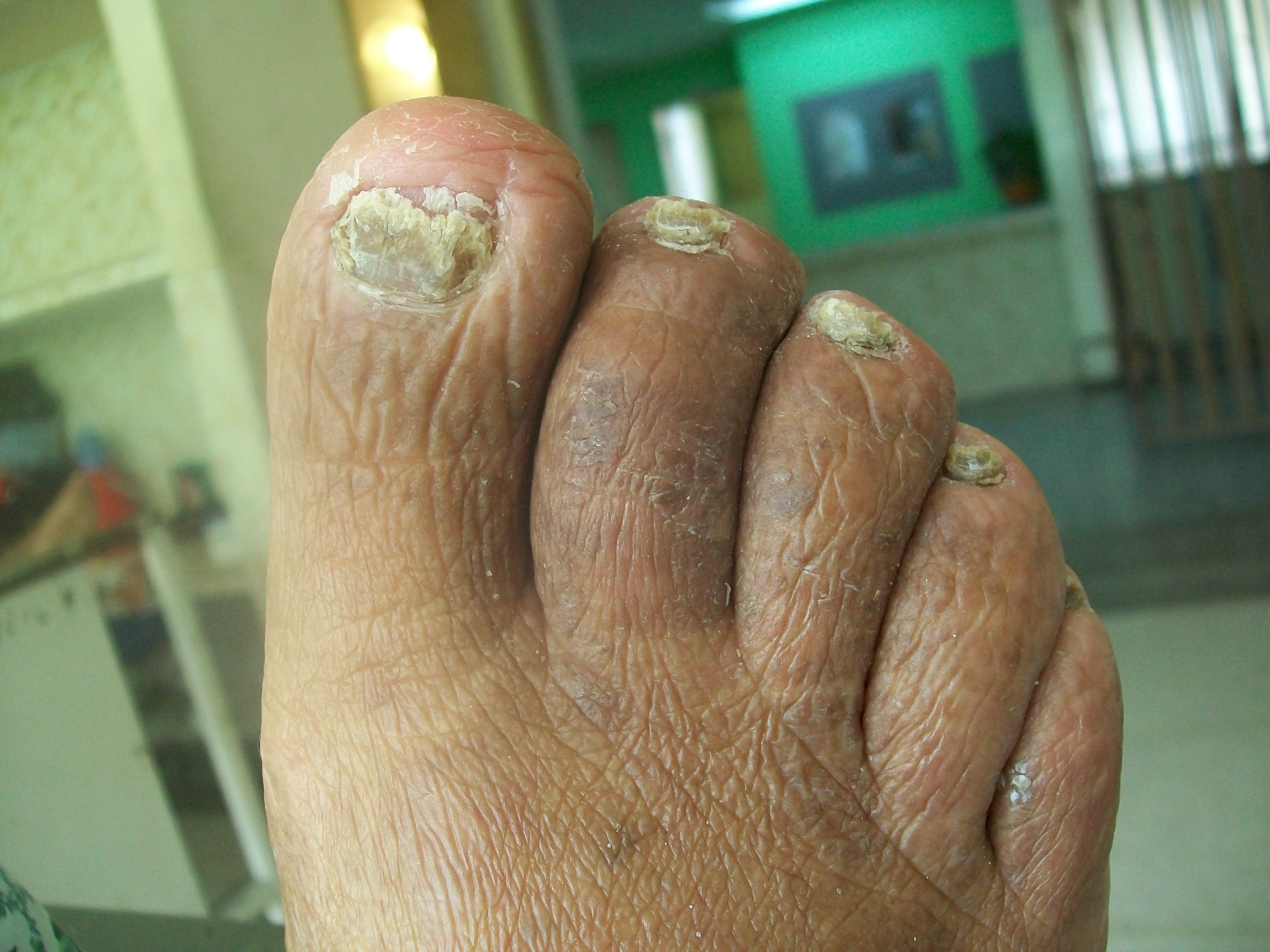 Alterações de cor e textura nas unhas